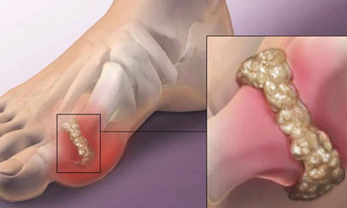 Gout treatment in Nagpur